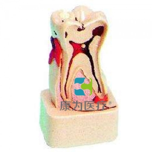 “康为医疗”牙体病综合病理模型(4倍大)