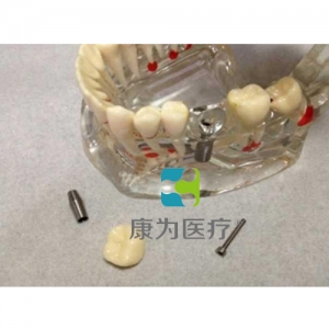 大庆“康为医疗”综合病理水晶牙列模型(可拆)