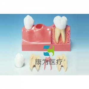 “康为医疗”牙分解模型（4倍大）