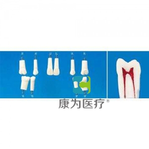 蚌埠“康为医疗”带髓腔的复合树脂牙